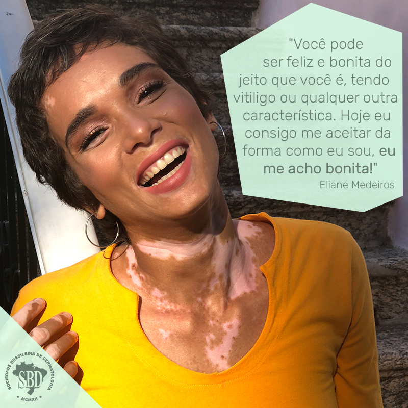 Em campanha da SBD, modelo profissional fala sobre como é viver com vitiligo